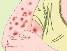 丘疹性荨麻疹会自愈吗